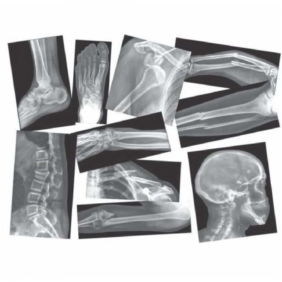 Broken Bones X-Rays (15pcs)